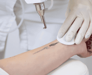 Effective Laser Tattoo Removal Machine