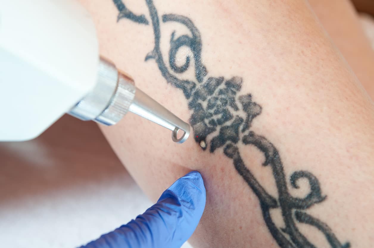 Choosing the Best Type of Laser Tattoo Removal